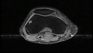 Knee MRI image
