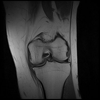 Association of MRI features and KL scores in knee osteoarthritis 3 Association of MRI features and KL scores in knee osteoarthritis 2